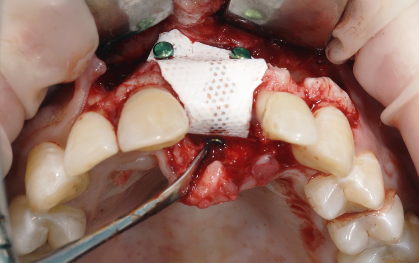 Quality Dental Membrane to Increase Soft Tissue