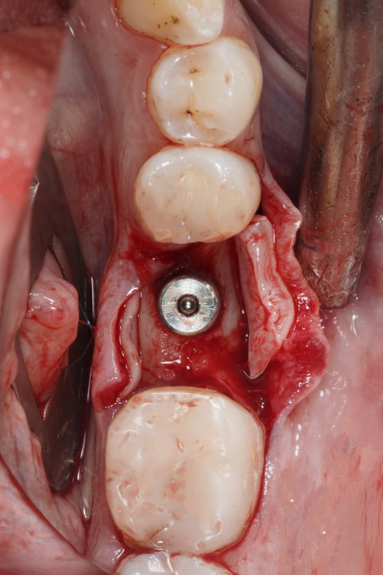 installed dental implant in the bone and gum shaper before sutur