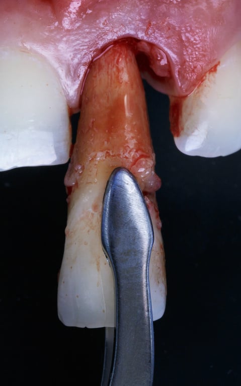 extracted front tooth before implantation