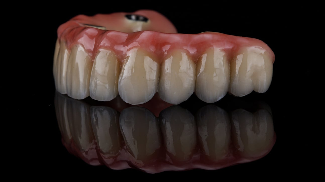 dental prosthesis of the upper jaw made of metal and ceramic