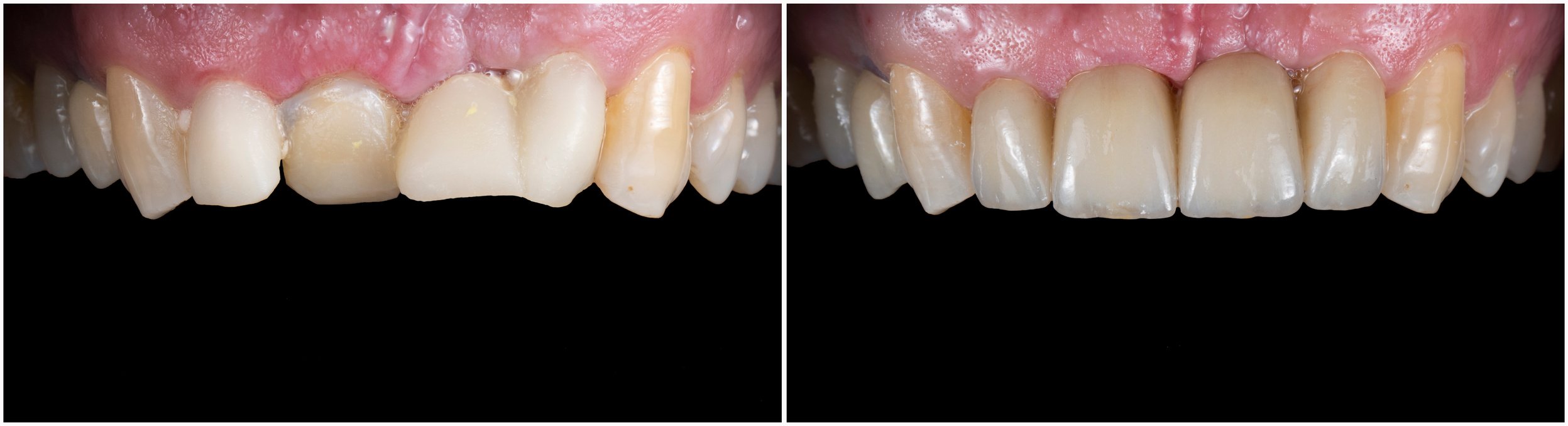 before and after picture for frontal teeth dental tratment by ceramic bridge