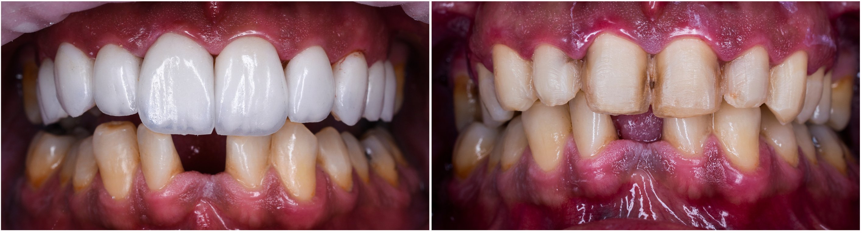 before and after picture for dental treatment with emax press ceramic veneers