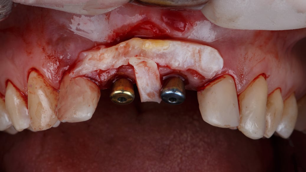 gum with overlaid volume  after implantation