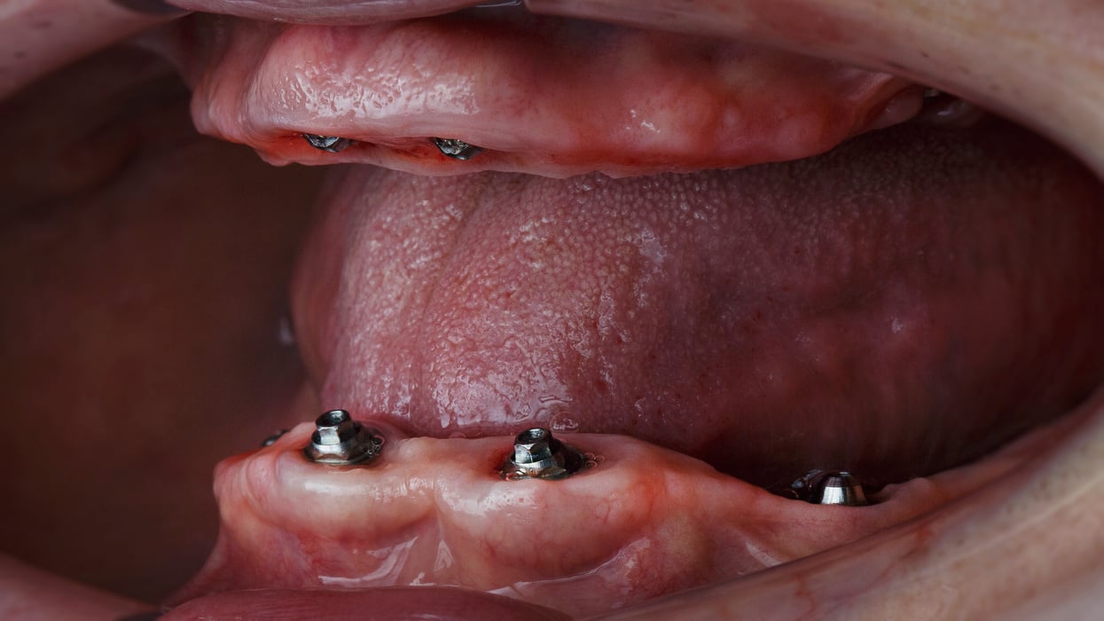 gingival cavity of two jaws with a prosthesis before installing