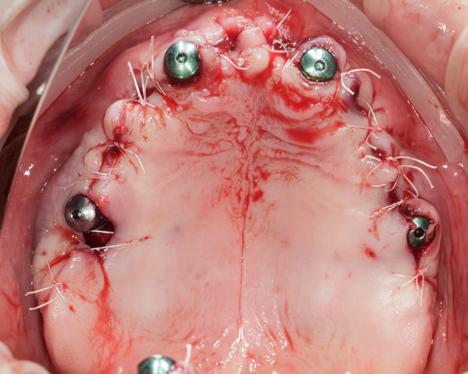 cavity of the sutured mucous membrane of the upper jaw after